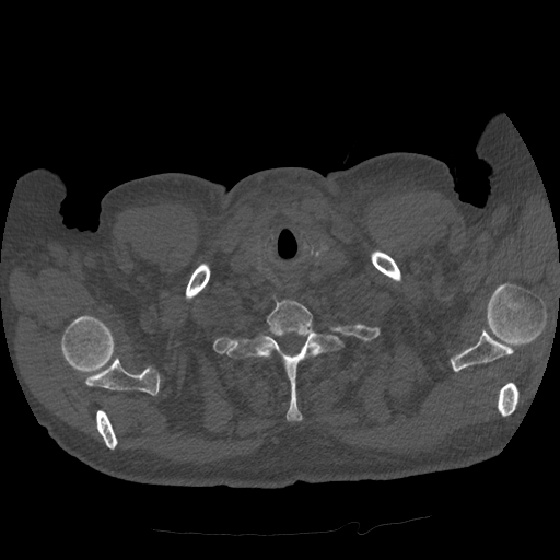 Bronchogenic carcinoma with metastatic lymphadenopathy (Radiopaedia 37671-39569 Axial bone window 2).jpg