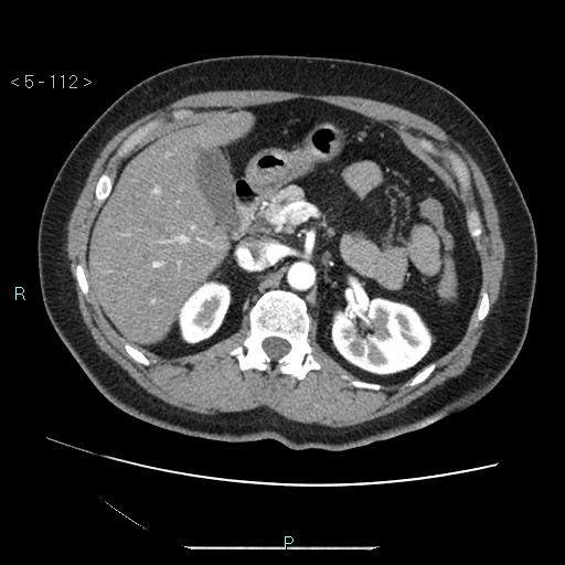 Bronchogenic cyst - posterior mediastinal (Radiopaedia 43885-47364 A 65).jpg