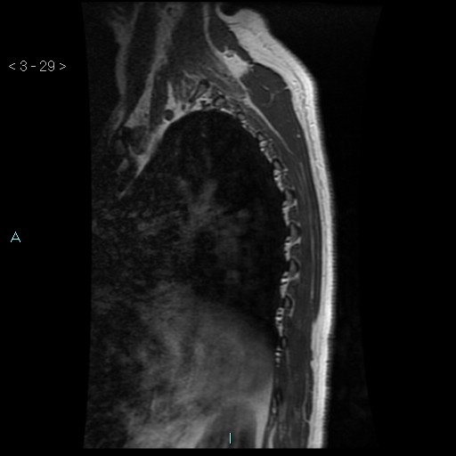 File:Bronchogenic cyst - posterior mediastinal (Radiopaedia 43885-47365 Sagittal T1 29).jpg