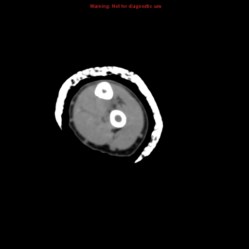 Brown tumor (Radiopaedia 12460-12694 Axial non-contrast 101).jpg