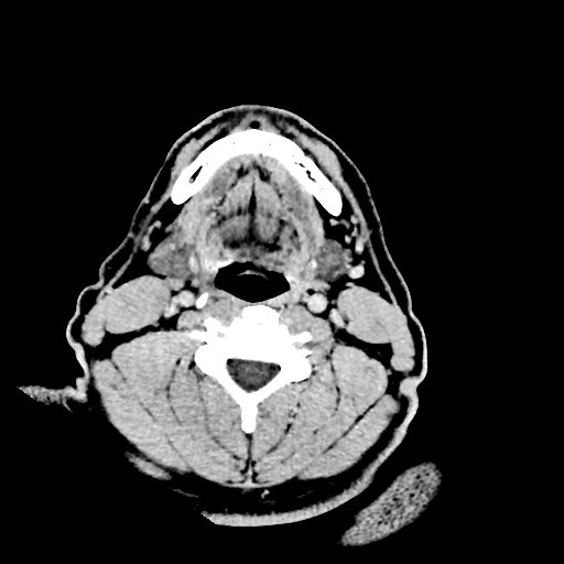 Buccal fat pad arteriovenous malformation (Radiopaedia 70936-81142 Axial non-contrast 2).jpg