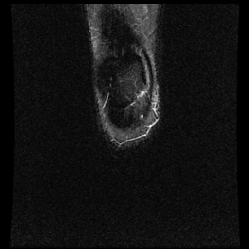 File:Bucket handle meniscus tear (Radiopaedia 56916-63751 Coronal STIR 1).jpg