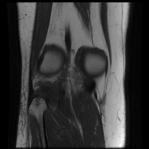 File:Bucket handle meniscus tear (Radiopaedia 56916-63751 Coronal T1 16).jpg