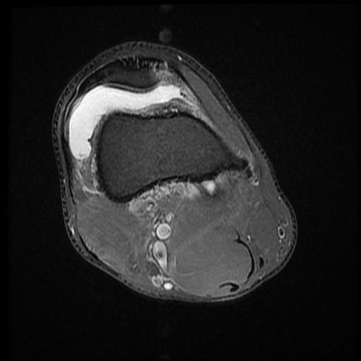 File:Bucket handle tear - medial meniscus (Radiopaedia 69245-79026 Axial PD fat sat 3).jpg