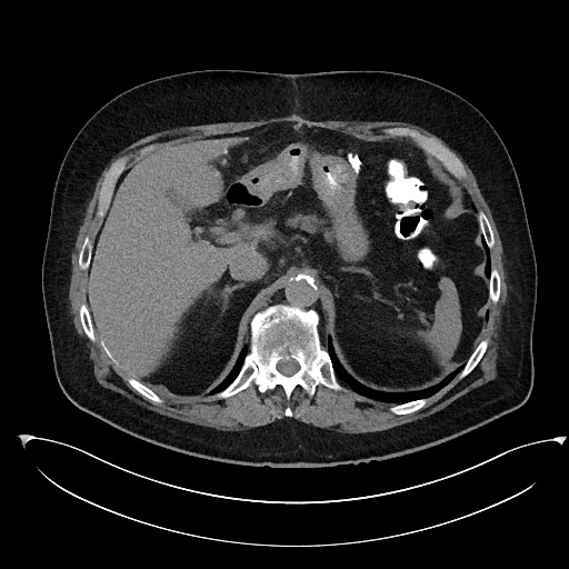 File:Buried bumper syndrome - gastrostomy tube (Radiopaedia 63843-72577 Axial Inject 25).jpg