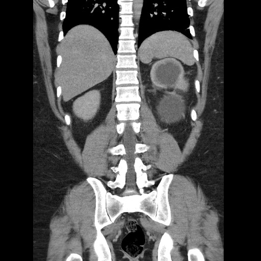 Burned-out testicular seminoma - retroperitoneal nodal metastases (Radiopaedia 62872-71245 B 49).jpg