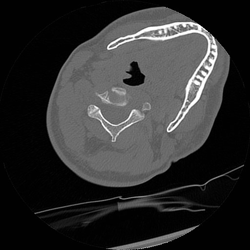 C1-C2 "subluxation" - normal cervical anatomy at maximum head rotation (Radiopaedia 42483-45607 Axial non-contrast 29).jpg