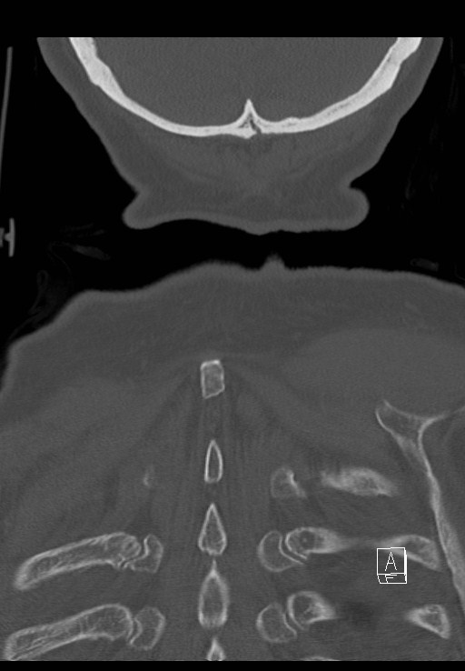 C1 and C2 (peg) fractures (Radiopaedia 36618-38184 Coronal bone window 53).jpg