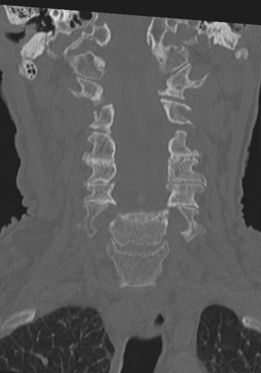C2 fracture with vertebral artery dissection (Radiopaedia 37378-39199 Coronal bone window 19).png