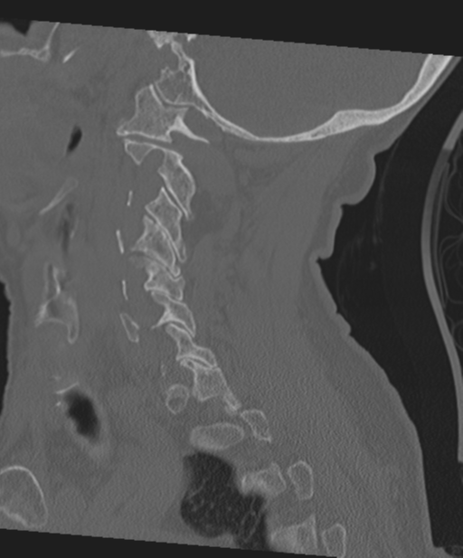 C2 fracture with vertebral artery dissection (Radiopaedia 37378-39199 Sagittal bone window 27).png