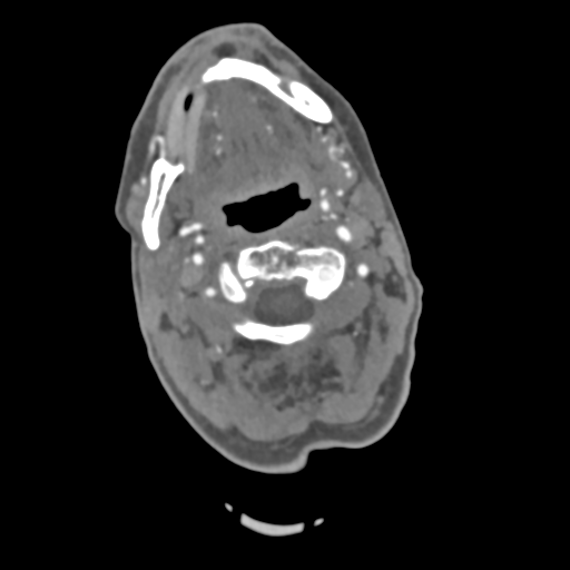 C2 fracture with vertebral artery dissection (Radiopaedia 37378-39200 A 167).png