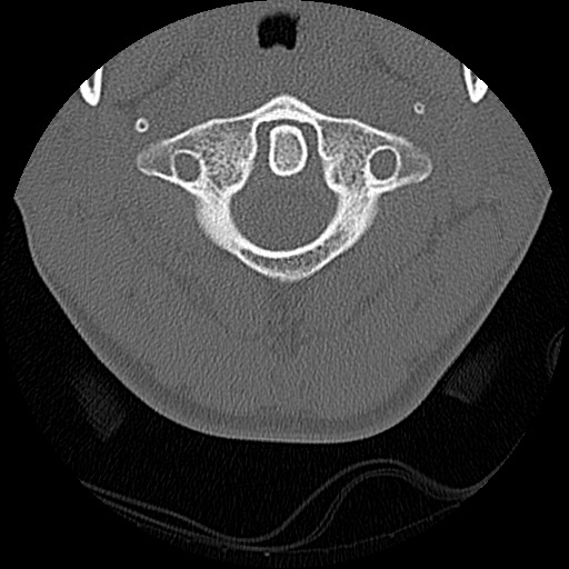 File:C5 facet fracture (Radiopaedia 58374-65499 Axial bone window 16).jpg