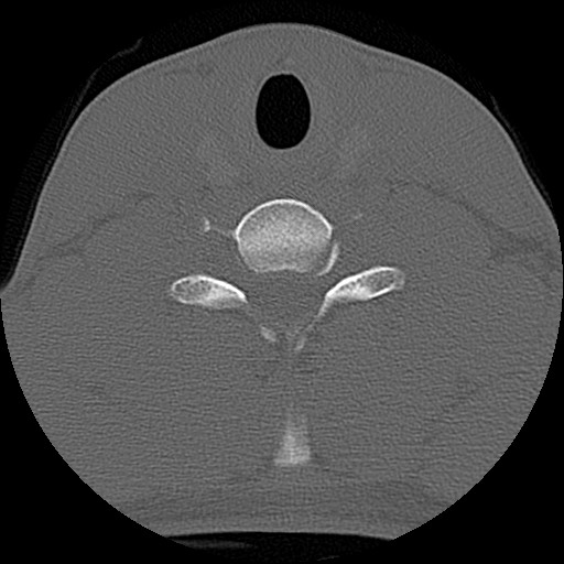 File:C5 facet fracture (Radiopaedia 58374-65499 Axial bone window 66).jpg
