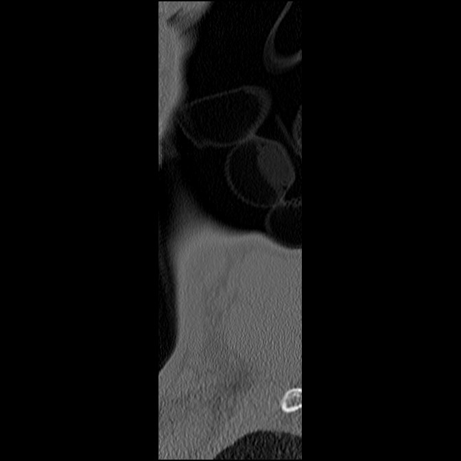 C5 facet fracture (Radiopaedia 58374-65499 Sagittal bone window 3).jpg