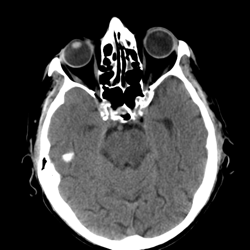 File:CNS lymphoma (Radiopaedia 36983-38639 Axial non-contrast 15).png
