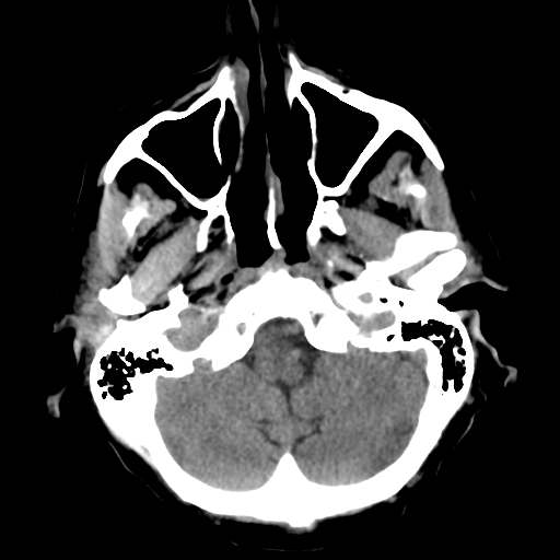 File:CNS lymphoma (Radiopaedia 36983-38639 Axial non-contrast 9).png