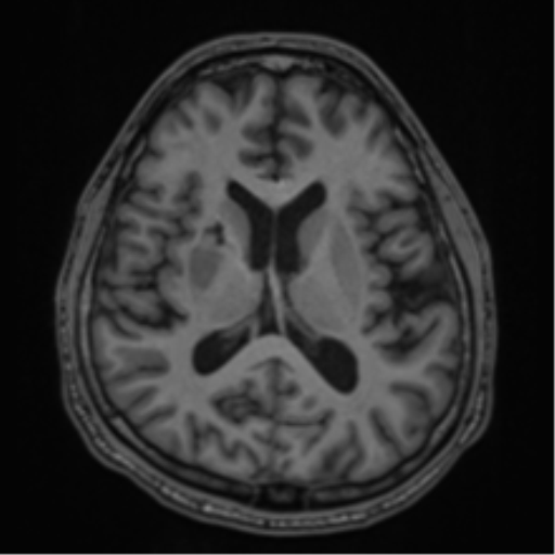CNS vasculitis (Radiopaedia 55715-62263 Axial T1 38).png