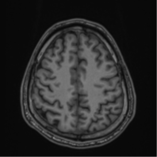 CNS vasculitis (Radiopaedia 55715-62263 Axial T1 71).png