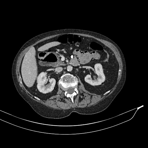 Calcified adrenal glands and Spigelian hernia (Radiopaedia 49741-54988 A 83).jpg