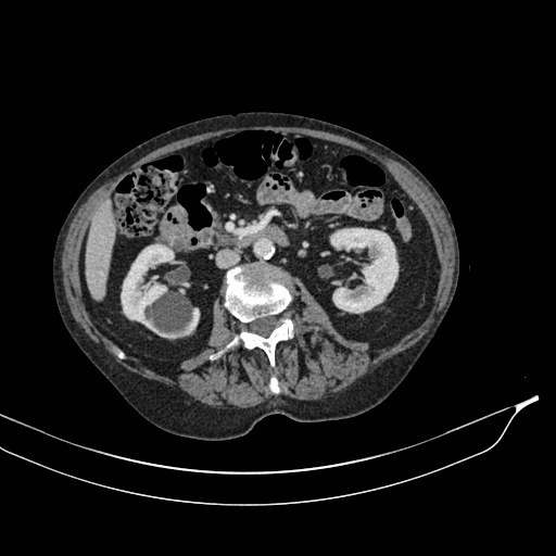 Calcified adrenal glands and Spigelian hernia (Radiopaedia 49741-54988 A 96).jpg