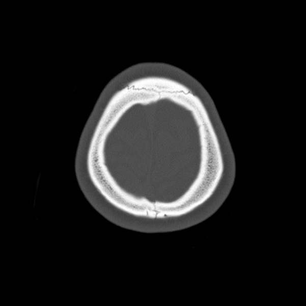 Calvarial osteoma (Radiopaedia 36520-38079 Axial bone window 99).jpg