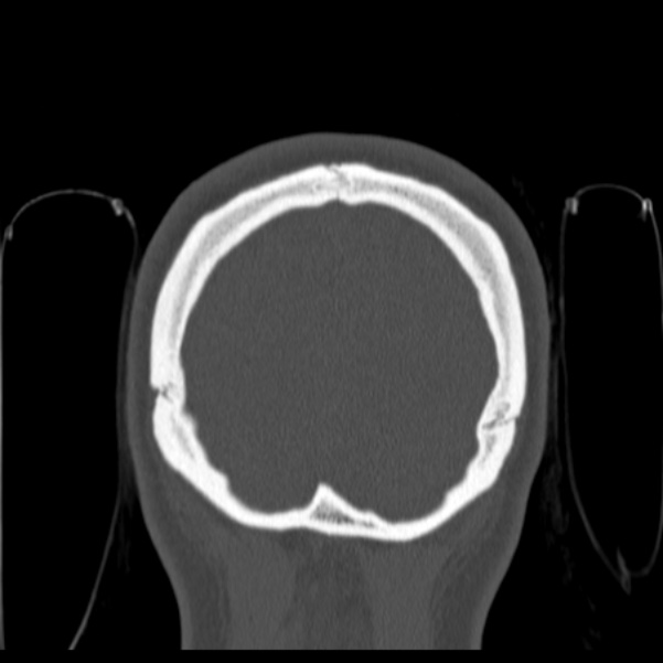 Calvarial osteoma (Radiopaedia 36520-38079 C 85).jpg