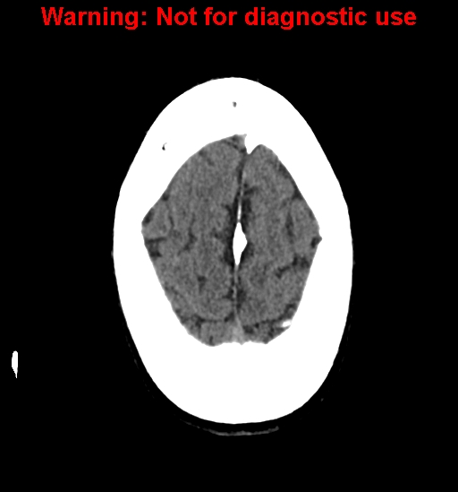 File:Calvarial thickening from chronic shunting (Radiopaedia 60079-67637 Axial non-contrast 26).jpg