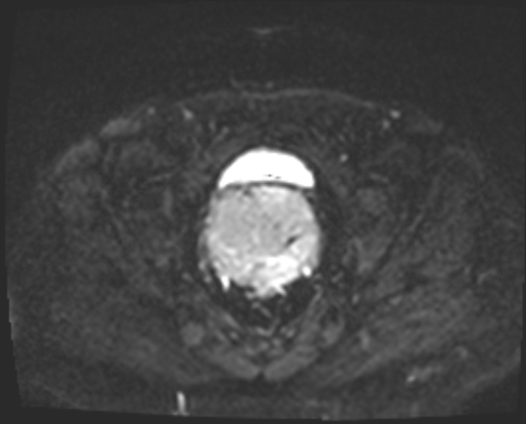 Cancer cervix - stage IIb (Radiopaedia 75411-86615 Axial DWI 14).jpg
