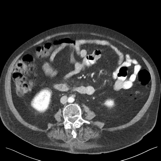 Cannonball metastases from endometrial cancer (Radiopaedia 42003-45031 E 41).png