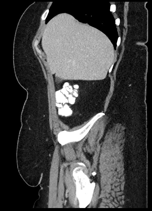 Carcinoid tumor - terminal ileum (Radiopaedia 60931-68739 C 86).jpg