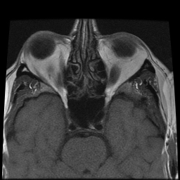 File:Carcinoid tumor of the ileum with metastasis to orbit (Radiopaedia 28165-28424 Axial T1 2).jpg
