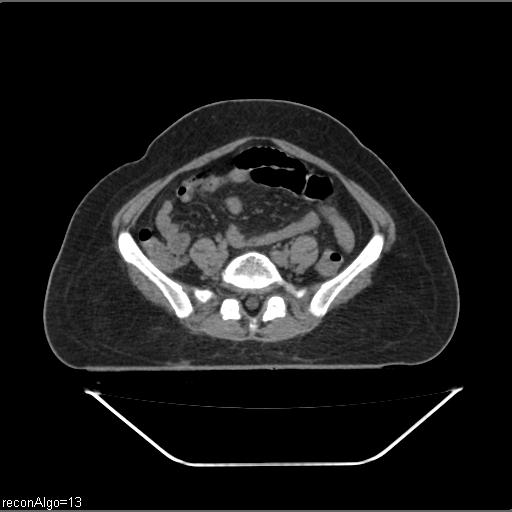 File:Carcinoma cervix- brachytherapy applicator (Radiopaedia 33135-34173 Axial non-contrast 2).jpg