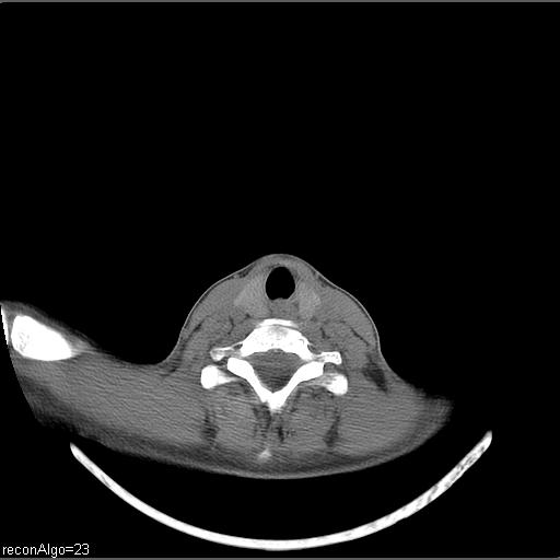 Carcinoma of the maxillary antrum (Radiopaedia 53805-59888 Axial non-contrast 17).jpg