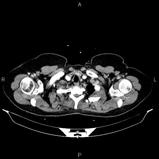 Carcinoma of uterine cervix (Radiopaedia 85861-101700 A 7).jpg