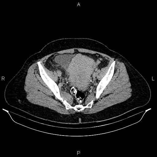 File:Carcinoma of uterine cervix (Radiopaedia 85861-101700 Axial C+ delayed 74).jpg