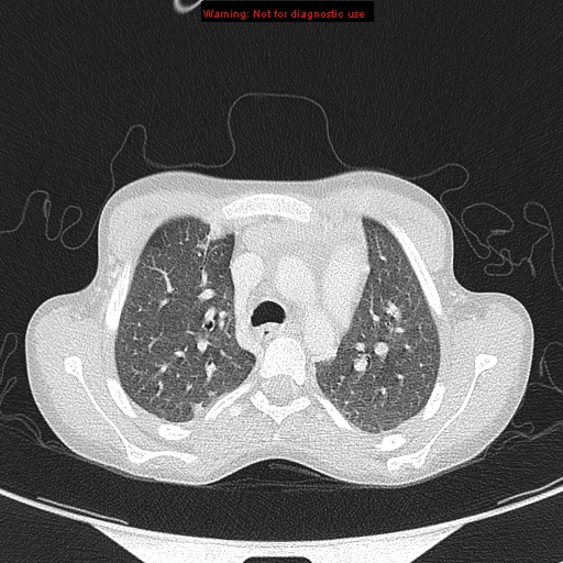 File:Cardiac bronchus (Radiopaedia 14059-13899 A 2).jpg