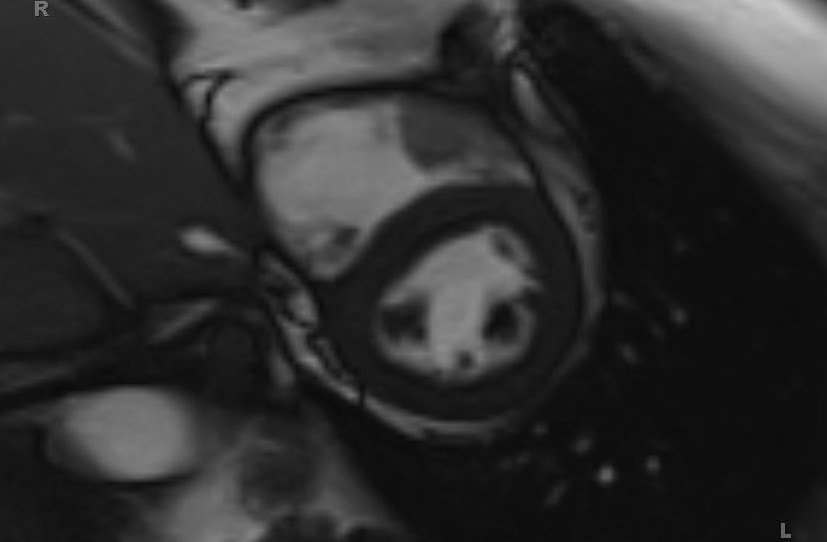 Cardiac hemangioma (Radiopaedia 31709-32631 Short axis Cine SSFP 19).jpg