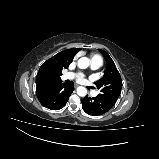 File:Cardiac hydatid disease (Radiopaedia 64684-73611 Axial with contrast 22).jpg