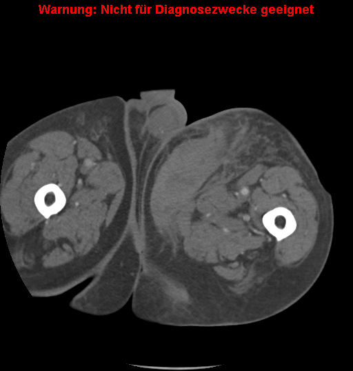 File:Cardiac perforation following transcatheter aortic valve implantation (Radiopaedia 23714-23863 B 32).png