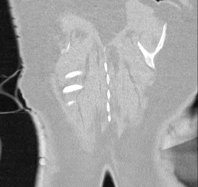 Cardiogenic pulmonary edema (Radiopaedia 29213-29609 Coronal lung window 65).jpg