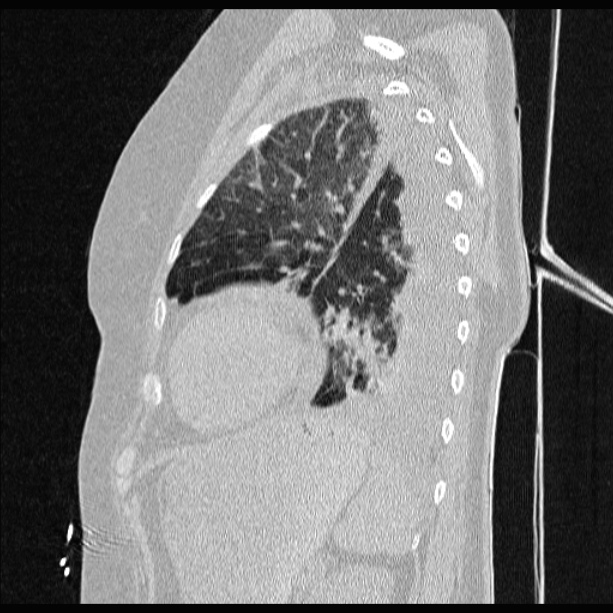Cardiogenic pulmonary edema (Radiopaedia 29213-29609 Sagittal lung window 73).jpg