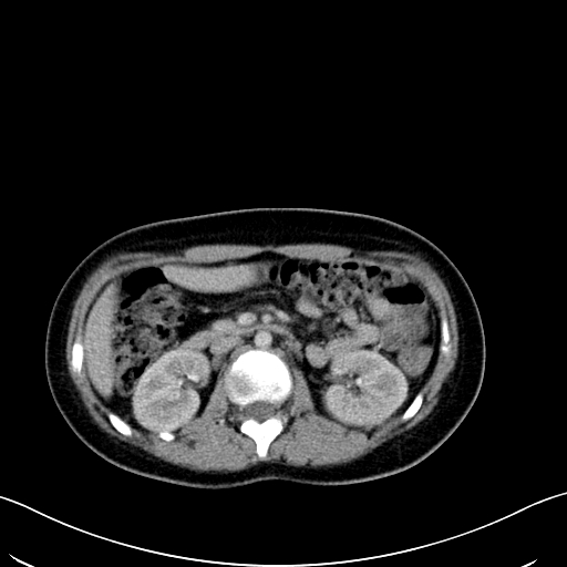 Caroli disease with medullary sponge kidney (Radiopaedia 82622-96804 C 30).jpg