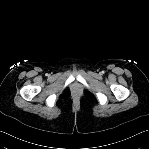 Caroli disease with medullary sponge kidney (Radiopaedia 82622-96804 C 80).jpg