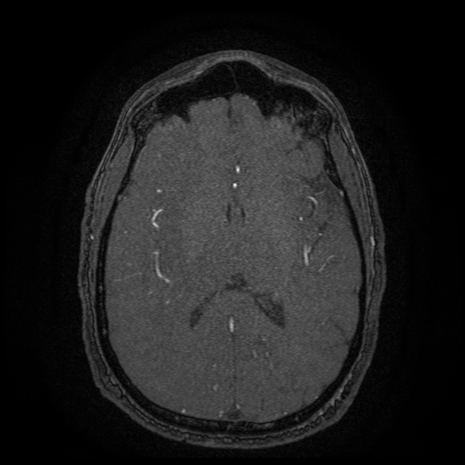 Carotid arterial dissection with acute cerebral infarction (Radiopaedia 26636-26784 MRA 68).jpg