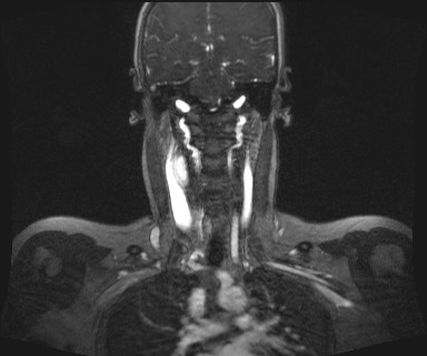 Carotid body tumor (Radiopaedia 12777-12912 MRA 41).jpg