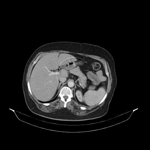 File:Carotid body tumor (Radiopaedia 21021-20948 B 64).jpg