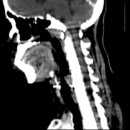 File:Carotid body tumor (Radiopaedia 27890-28124 C 10).jpg