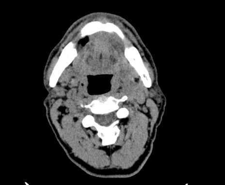 File:Carotid body tumor (Radiopaedia 61750-69757 Axial non-contrast 36).jpg