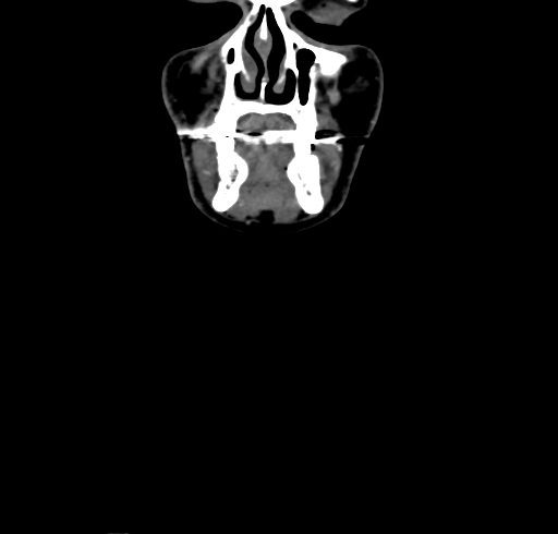 File:Carotid body tumor (Radiopaedia 83615-98727 B 5).jpg