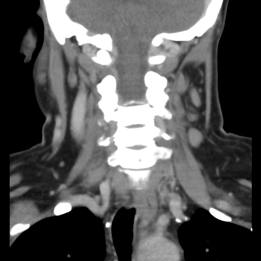 File:Carotid body tumor (paraganglioma) (Radiopaedia 38586-40729 B 28).jpg